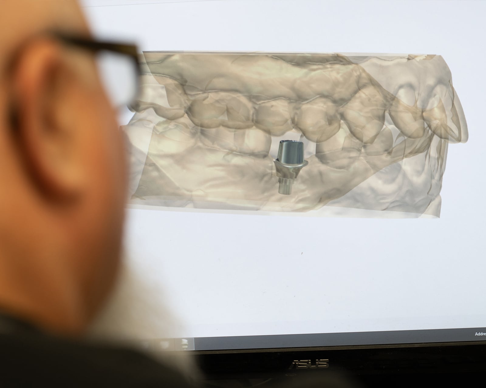 Dentist looking at 3D model of teeth on a screen.