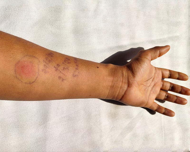 Example of TB Screening on arm.