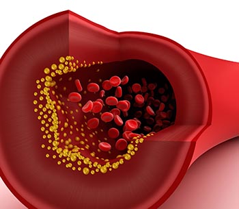 cholesterol_in_blood_vessel_s