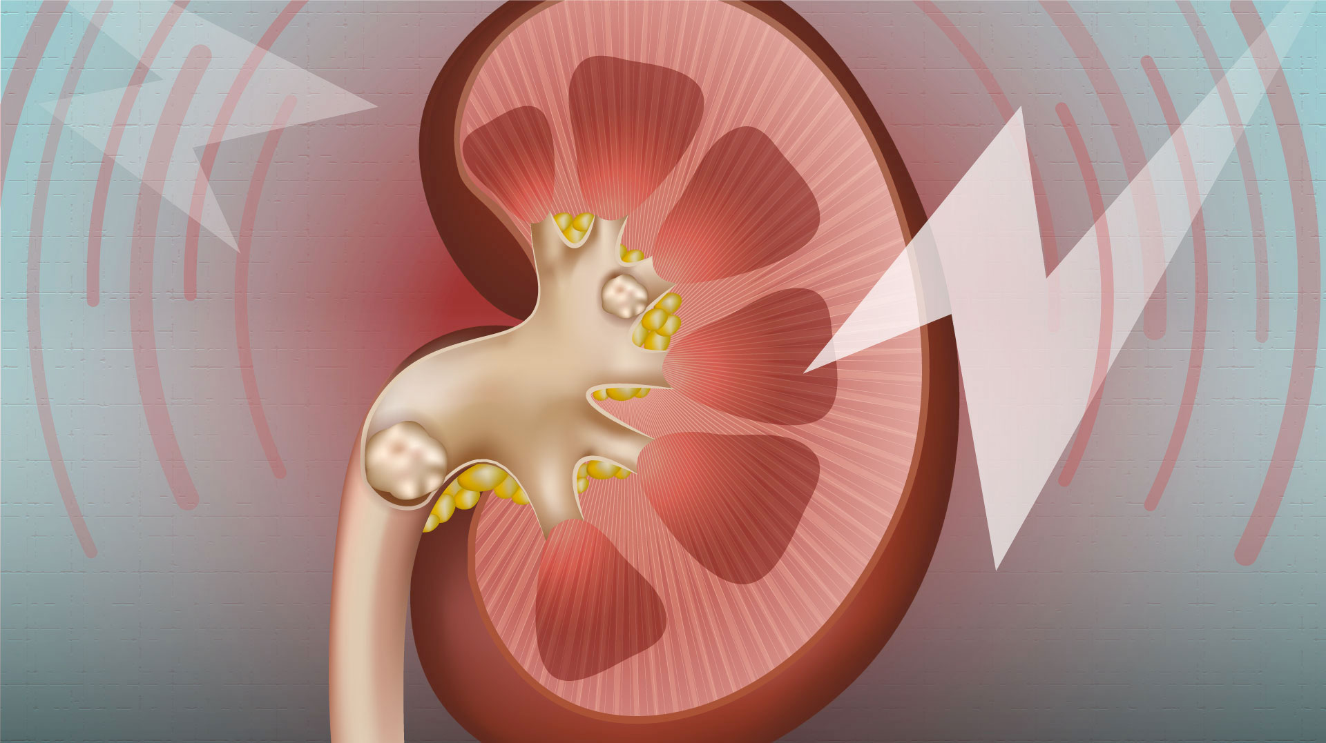 uab-news-kidney-stones-a-marker-of-overall-kidney-health
