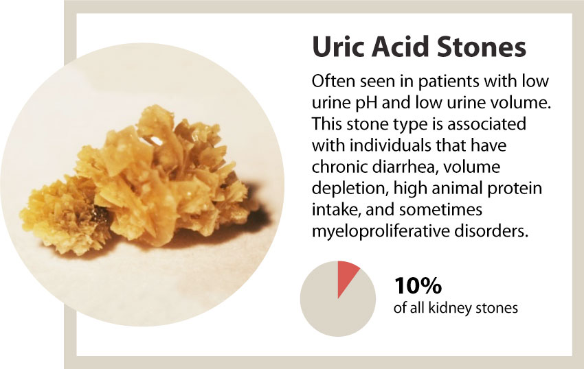 kidney stones uric
