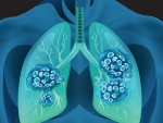 Frankly Speaking about Lung Cancer