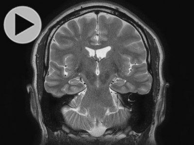 UAB/Auburn study will test new MRI technique for epilepsy
