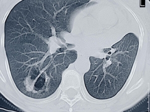 UAB offers CT scan for early detection of lung cancer