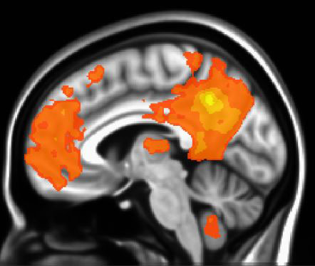 Brain scan with activated areas denoted in orange. 
