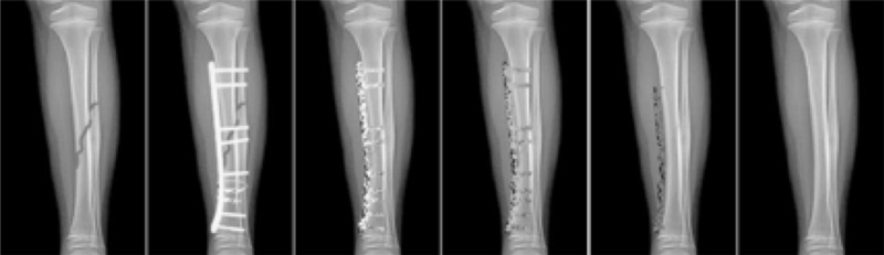 Pictures showing the progression of a fractured bone and the medical implants used to heal it. 