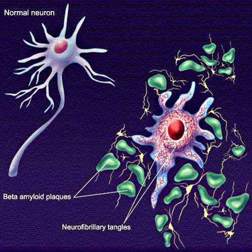 image showing neurofibrillary tangles