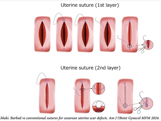 Figure 1 illustrates the first and second layers of uterine sutures using the barbed technique.
