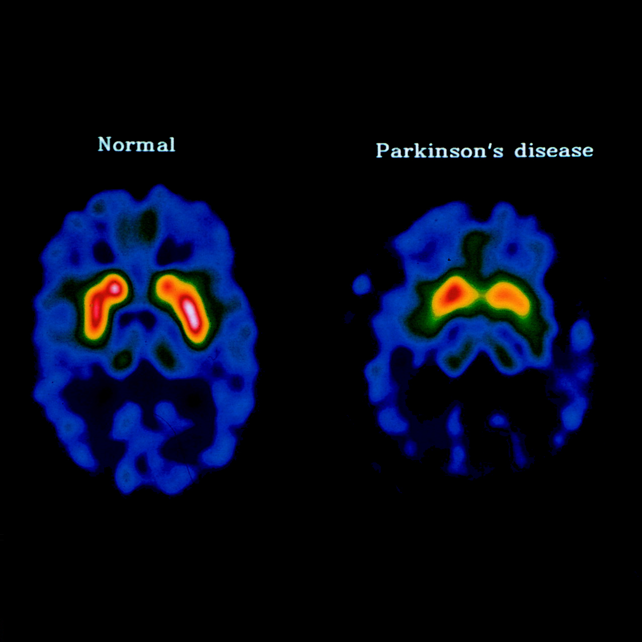 Research computing team aids investigating Parkinson's