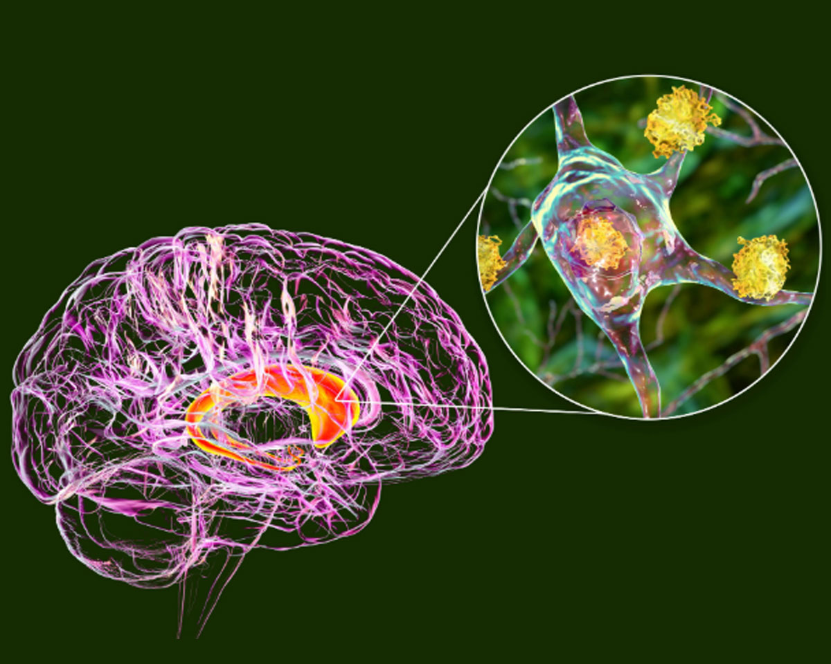 Huntington’s Disease Breakthrough