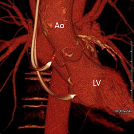 Cardiac TAVR 275x275