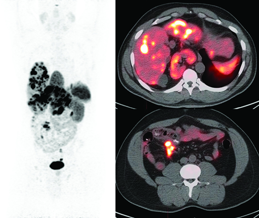 Neuroendocrine PET CT