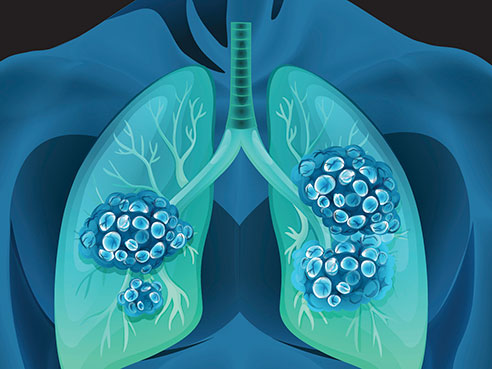 lung cancer2