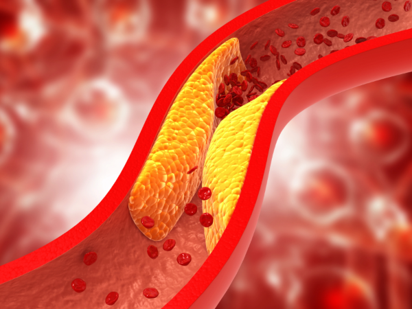 Atherosclerosis is depicted in a vein with blood cell build-up