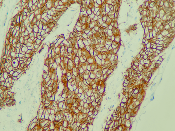 UAB breast pathologists publish on reproducibility of HER2 testing in breast cancer