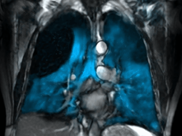 CLAIR and Research MRI Core launch groundbreaking Xenon-129 lung imaging at UAB