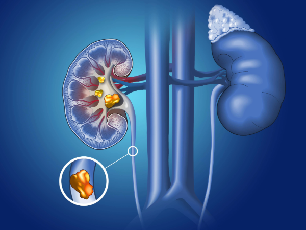 Understanding the connection between GLP‑1 medications and kidney stone risk