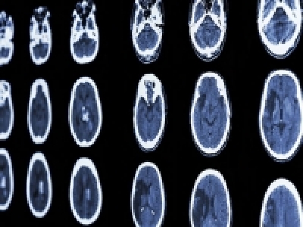 Stroke accelerates cognitive decline over time, study finds