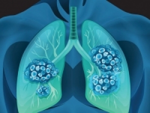 Frankly Speaking About Lung Cancer