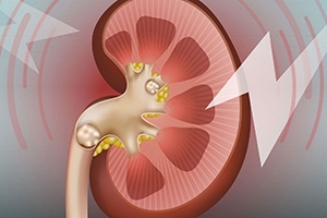 Kidney stones, a marker of overall kidney health