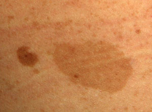 flat brown spots on skin