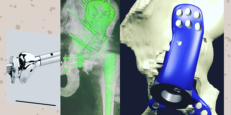  (Left to Right) Modern distal femur replacement, customized design for pelvic reconstruction, and 3D pre op computerized model plan.