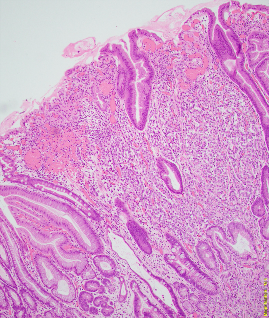 Condyloma Lata spirochete IHC high power1