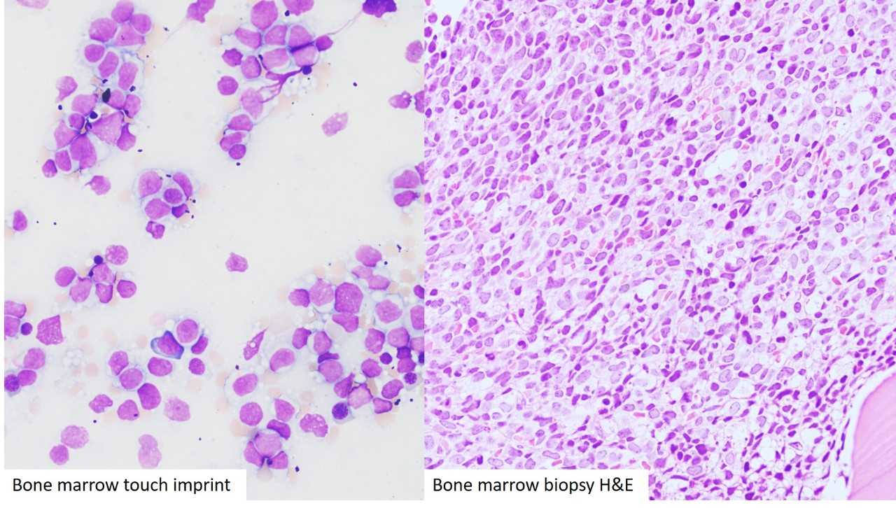 Bone density in acute leukemia