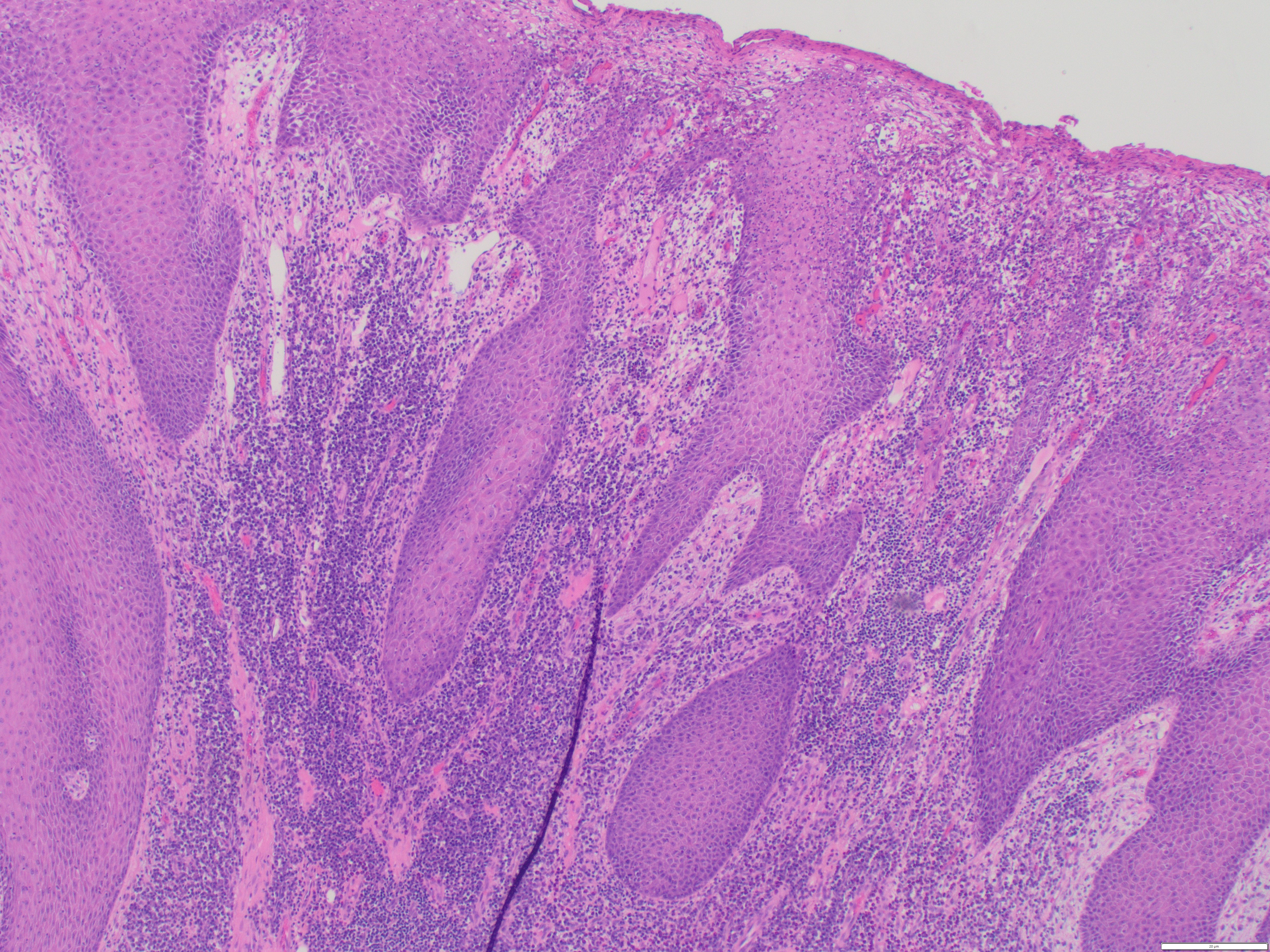 Condyloma Lata low power