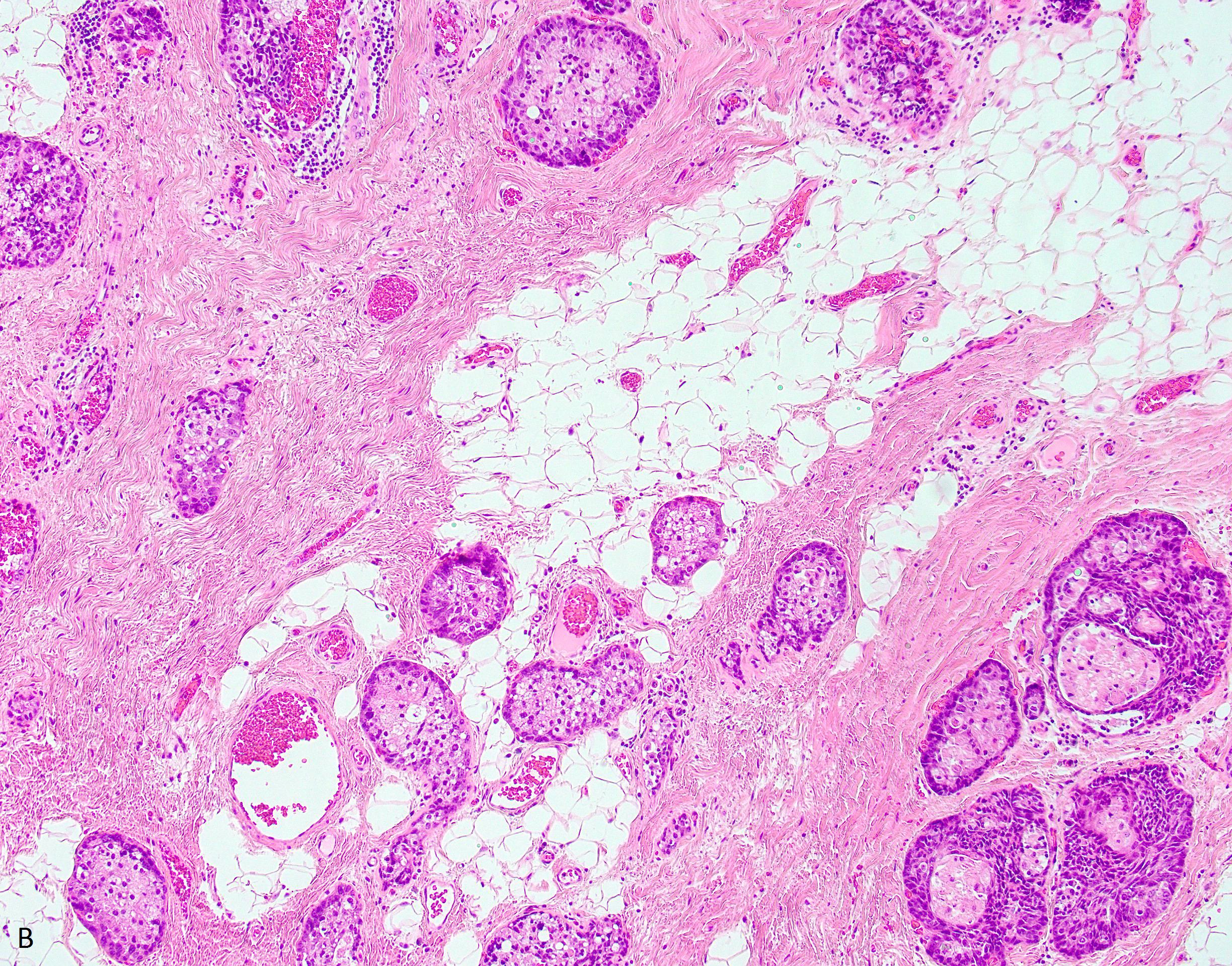 Sebaceous Carcinoma 10x