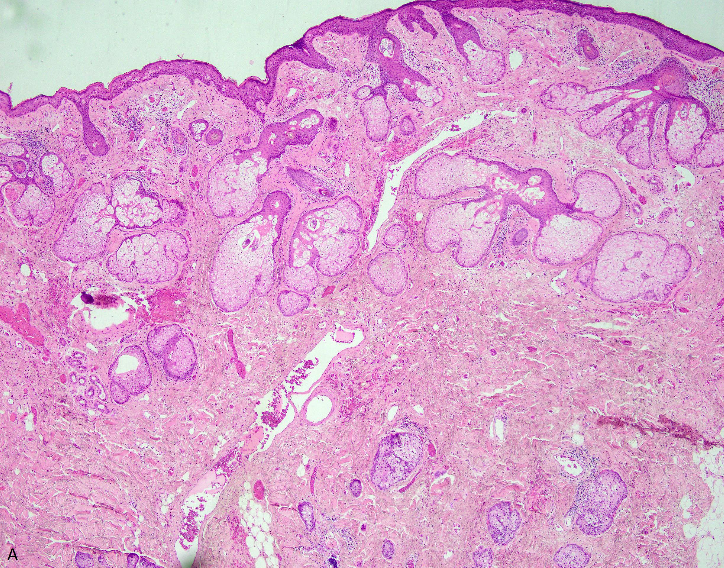 Sebaceous Carcinoma 4x