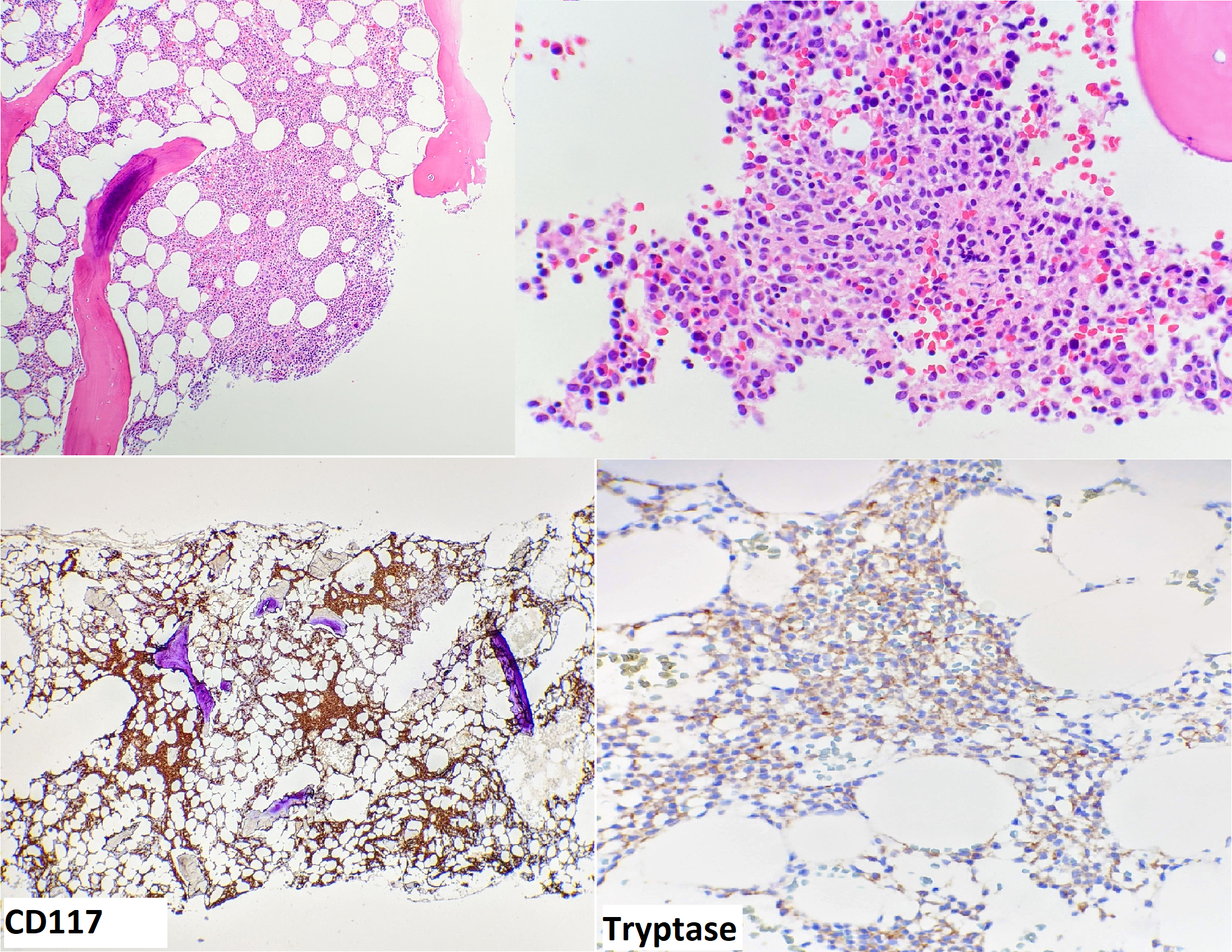 MarrowBiopsy.png
