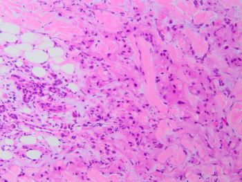 salivary duct ca HE 20x