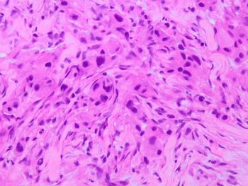 salivary duct ca HE 40x