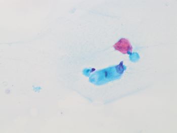 salivary duct ca pap 40x