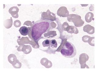 hemophagocytosissmall