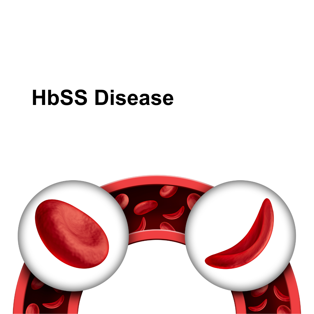 Homozygous Sickle Cell Disease