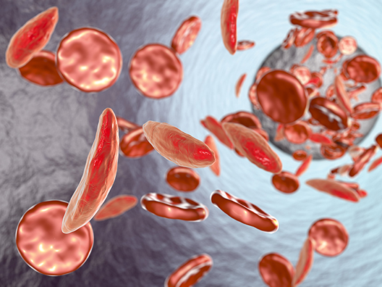 Sickle cell anaemia. Artwork showing normal red blood cells (round), and red blood cells affected by sickle cell anaemia (crescent shaped). This is a disease in which the red blood cells contain an abnormal form of haemoglobin (bloods oxygen-carrying pigment) that causes the blood cells to become sickle-shaped, rather than round. Sickle cells cannot move through small blood vessels as easily as normal cells and so can cause blockages (right). This prevents oxygen from reaching the tissues, causing severe pain and organ damage.