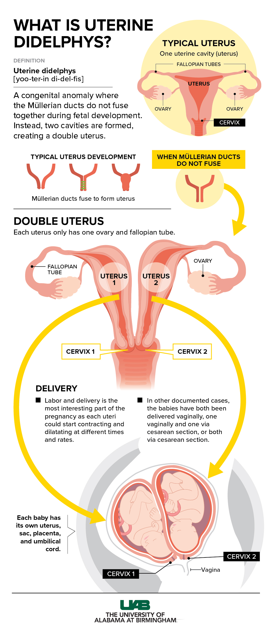 Twin Uterus graphic 2