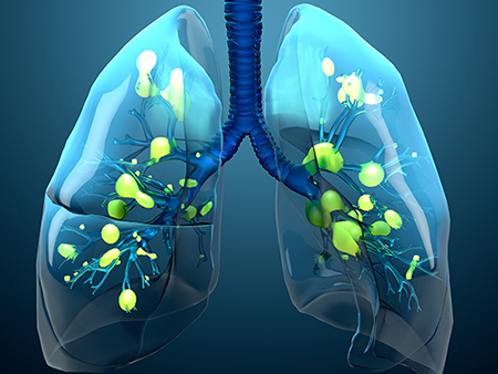 Damage lungs, severe respiratory illness, pneumonia, ARDS, acute respiratory distress syndrome caused by the coronavirus