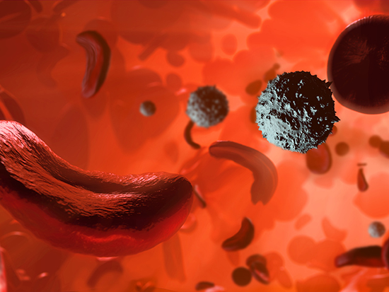 Sickle cell anaemia. Illustration showing white blood cells (round, white), normal red blood cells (round), and red blood cells affected by sickle cell anaemia (crescent shaped). This is a disease in which the red blood cells contain an abnormal form of haemoglobin (blood's oxygen-carrying pigment) that causes the blood cells to become sickle-shaped, rather than round. Sickle cells cannot move through small blood vessels as easily as normal cells and so can cause blockages. This prevents oxygen from reaching the tissues, causing severe pain and organ damage.