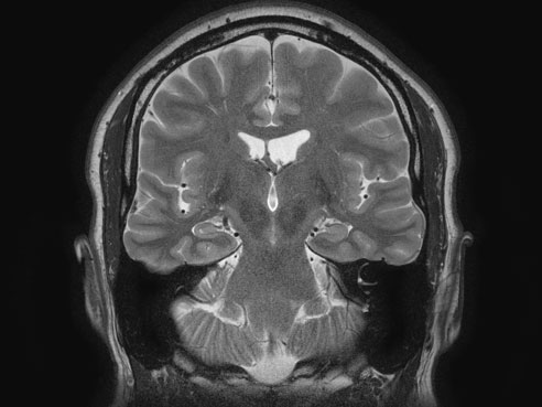 brain scan verhoef