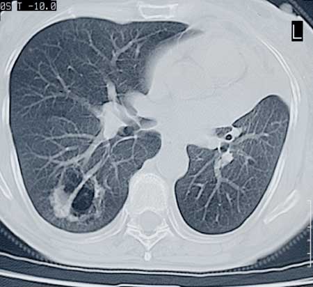 dransfield-lung-CT s
