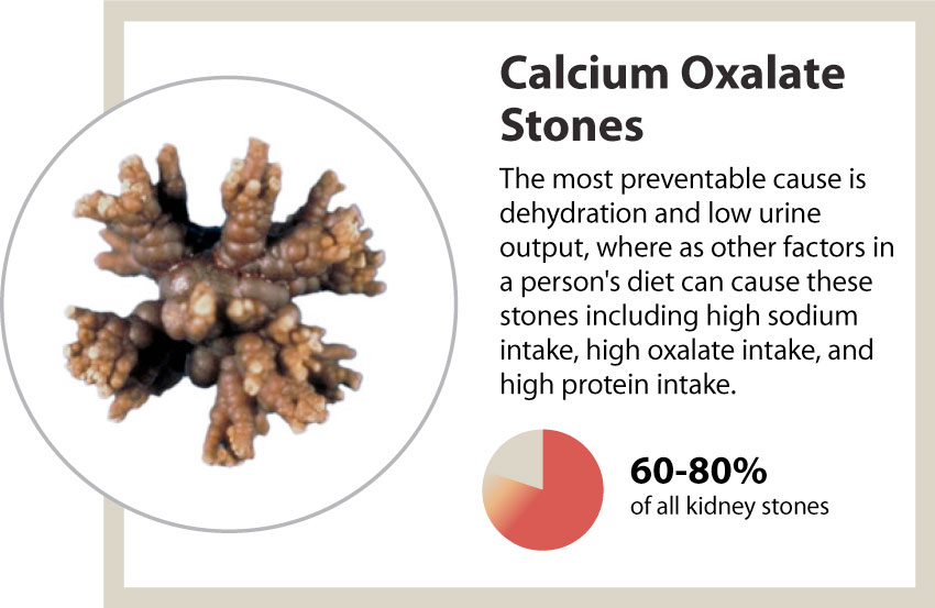 kidney stones calcium