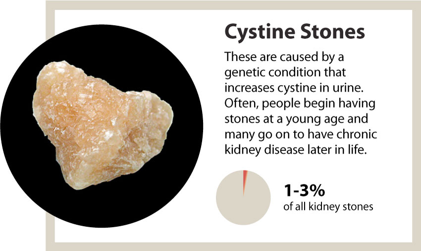 kidney stones cystine