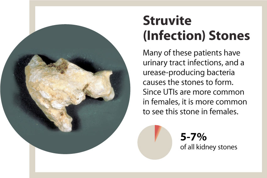 kidney stones struvite