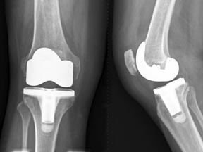 knee_joint_story