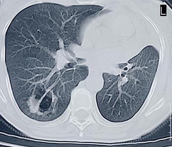 dransfield_CT_lung_cancer_s
