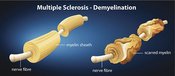 multiple sclerosis 2