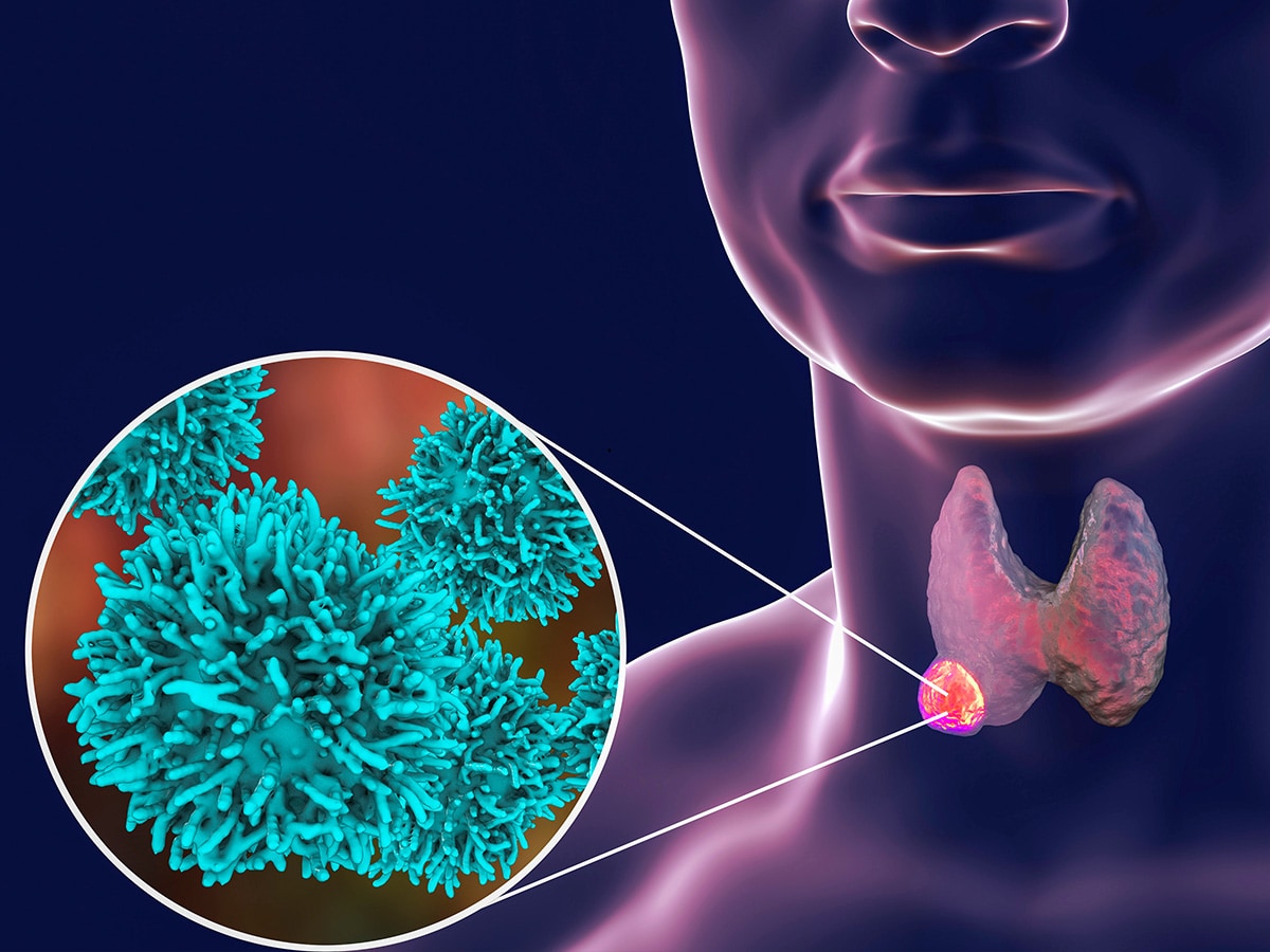 New discovery explores potential aggressive thyroid cancer treatment 